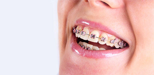 Tips For Adults With Braces